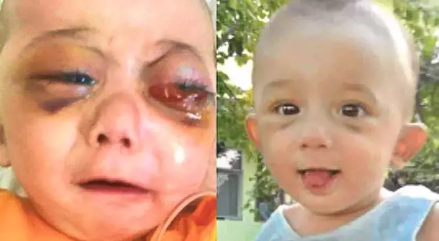 Ojos Panda (Black Eye Pedo and Panda Eyes)