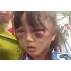 Ojos Panda (Black Eye Pedo and Panda Eyes)