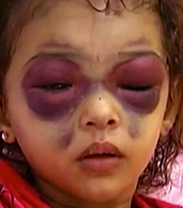 Ojos Panda (Black Eye Pedo and Panda Eyes)